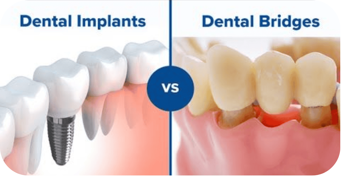 Dental Implants vs Bridges: Which Is Right for Missing Teeth?