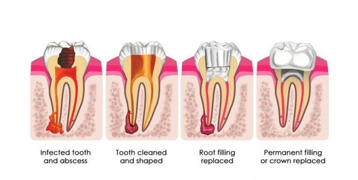 Painless Root Canal in Hyderabad: Myths Busted & Facts You Must Know.