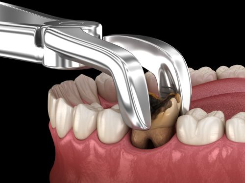 Tooth Extraction Aftercare: Do’s and Don’ts and Healing Tips.