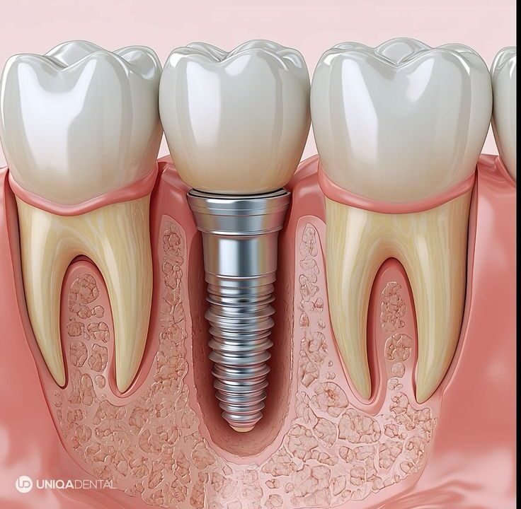 Dental Implants in Hyderabad: A Permanent Set of Teeth for Better Living.