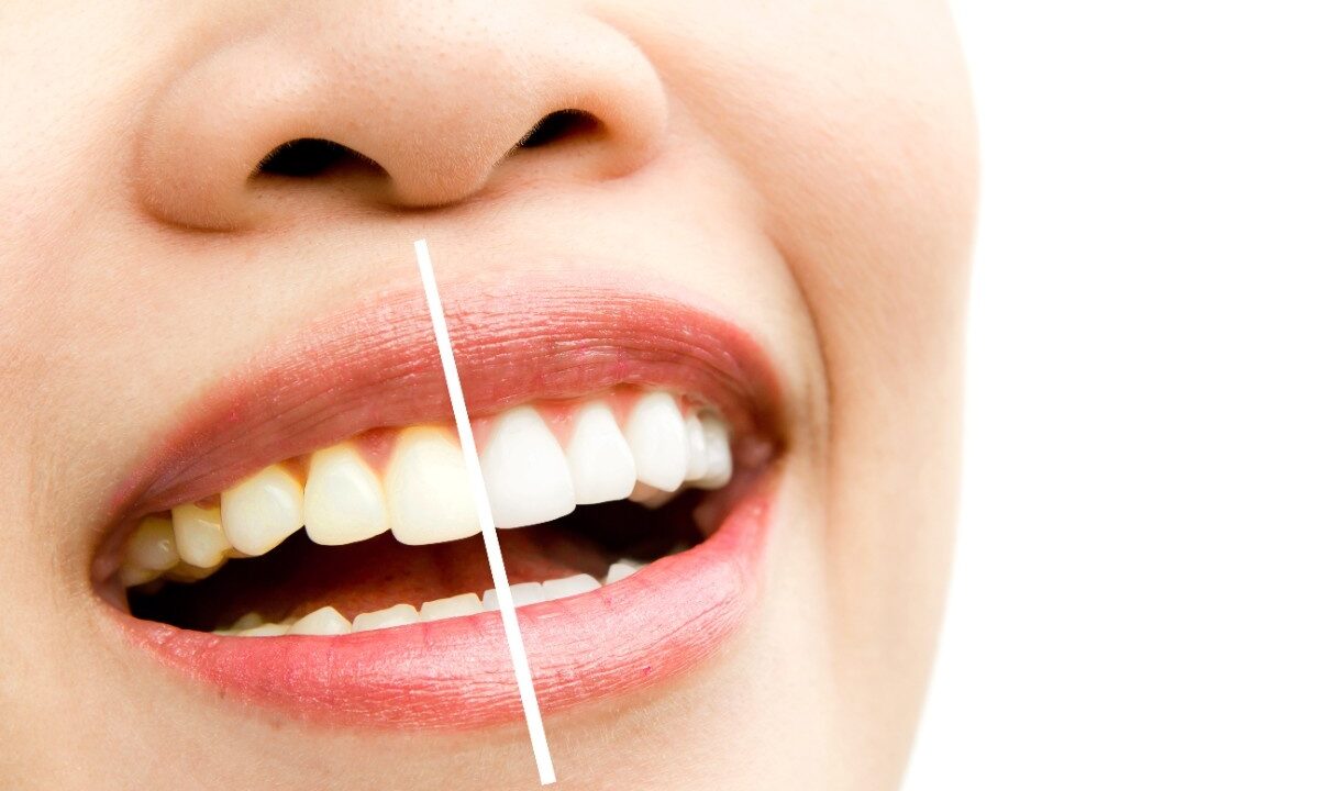 Teeth Cleaning, Polishing & Laser Whitening in Hyderabad