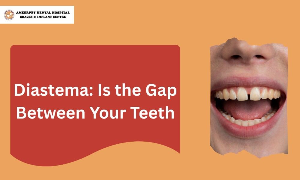 Diastema