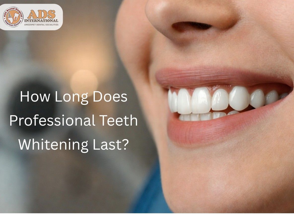 Visual representation of Professional Teeth Whitening results and how long teeth remain bright after treatment