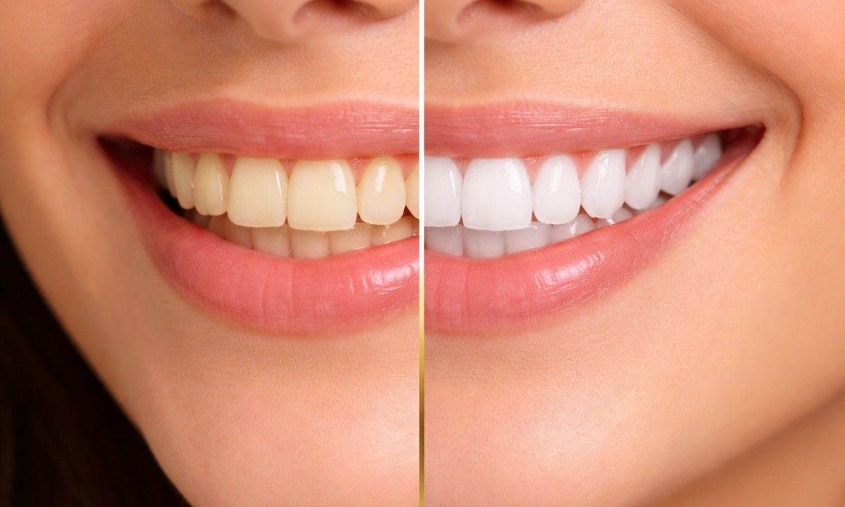 Best Teeth Whitening Treatment in Hyderabad