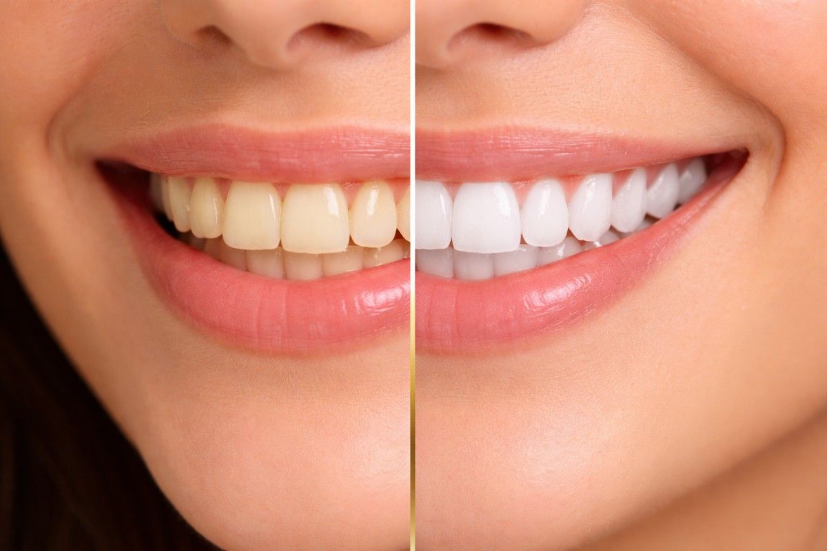 Teeth Whitening Treatment: Before and after image showing a smile with yellowish teeth and a bright, white smile post-treatment
