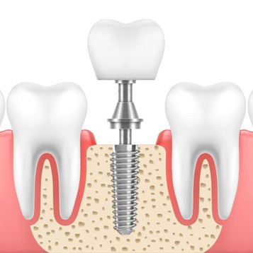 Pediatric Dentistry in Gachibowli