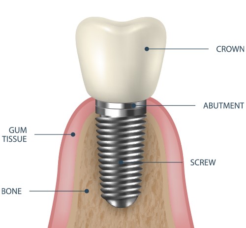 Pediatric Dentistry in Gachibowli