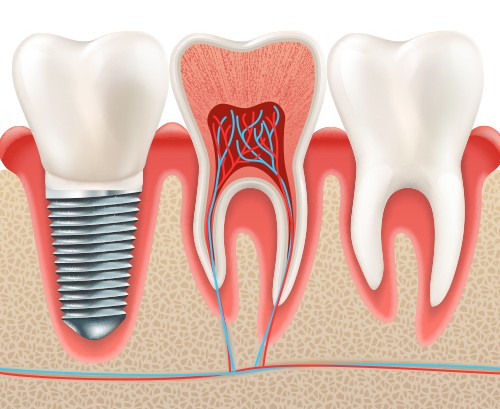 teeth replacement in gachibowli