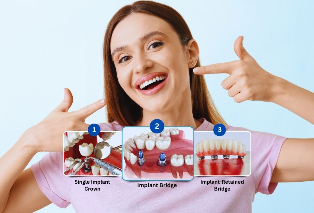 Dental Implants treatment at ADS Dental Hospitals Hyderabad
