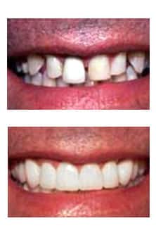 Cosmetic dentistry result ADS Dental Hyderabad