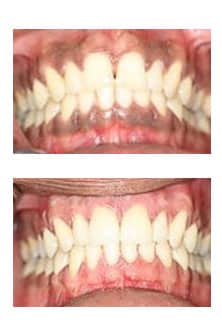 Cosmetic dentistry result ADS Dental Hyderabad