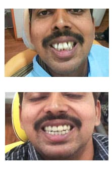 Cosmetic dentistry result ADS Dental Hyderabad