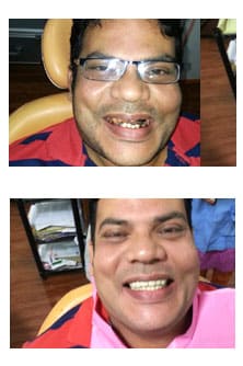 Cosmetic dentistry result ADS Dental Hyderabad