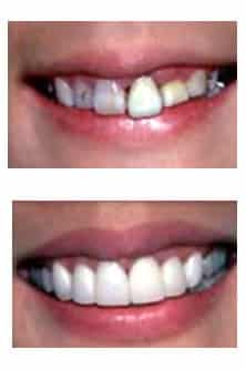 Cosmetic dentistry result ADS Dental Hyderabad