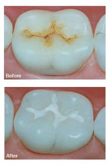Cosmetic dentistry result ADS Dental Hyderabad