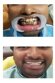 Cosmetic dentistry result ADS Dental Hyderabad