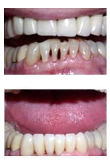 Cosmetic dentistry result ADS Dental Hyderabad