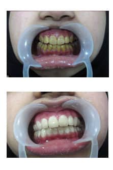 Cosmetic dentistry result ADS Dental Hyderabad