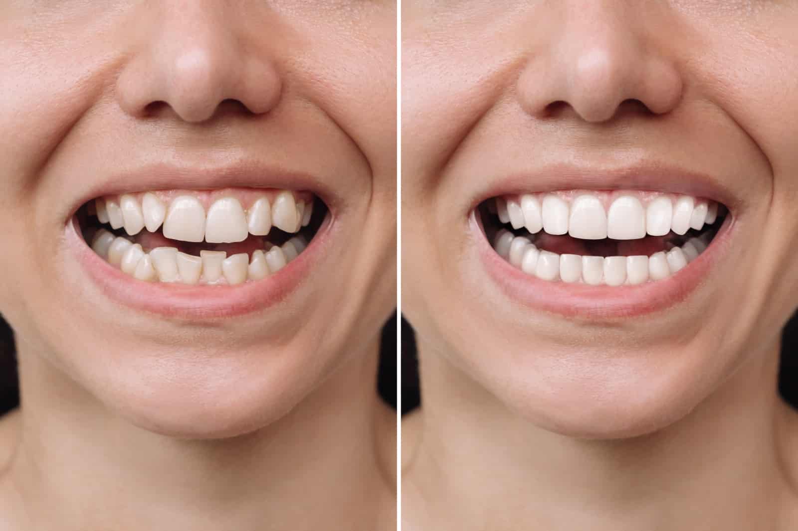 Before & After Restorative Treatment at ADS Dental Hospitals