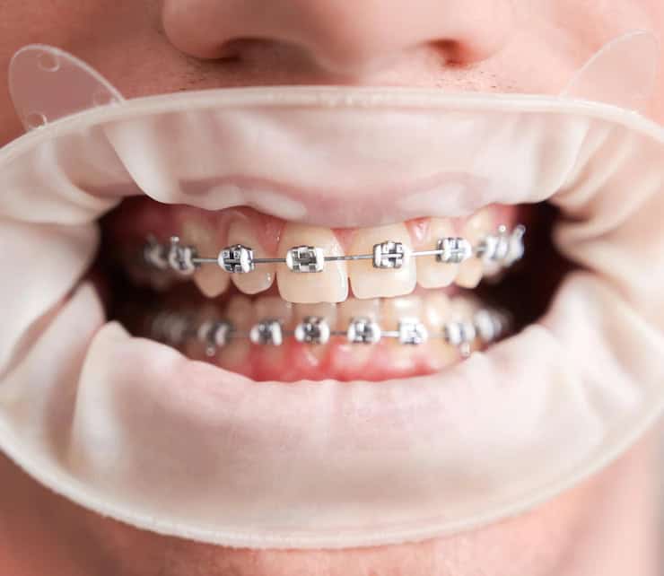 Braces & Aligners in Hyderabad — ADS Dental Hospital